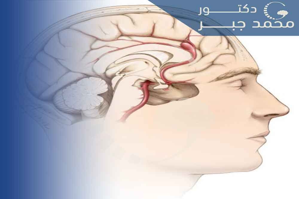اعراض التمدد الشرياني في المخ