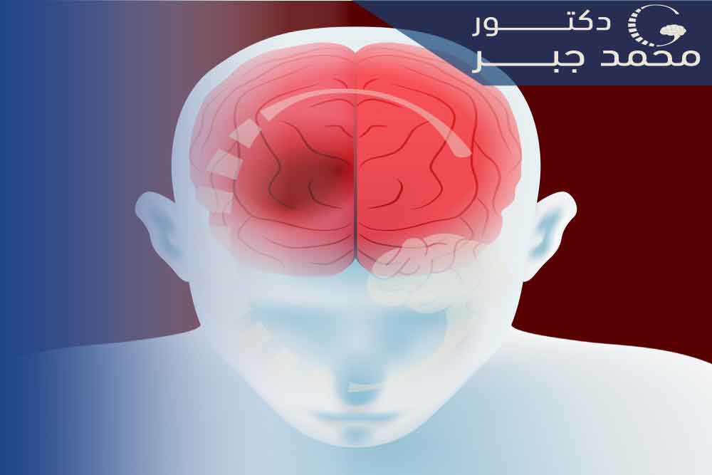 ما المقصود بالوحمة الشريانية الدموية بالمخ أو التشوه الشرياني بالمخ؟